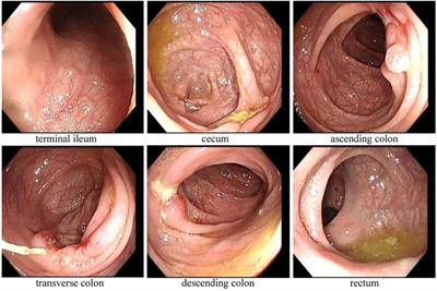 Crohn's disease after multiple doses of rituximab treatment in a child with refractory nephrotic syndrome and an ATG2A mutation: a case report